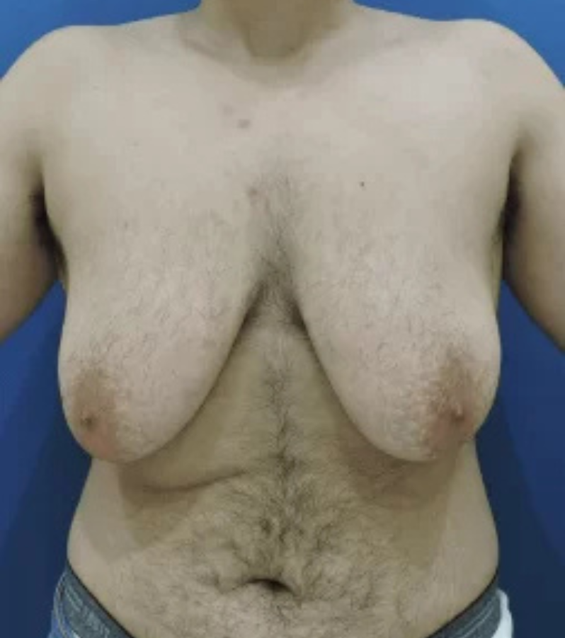 Before photo of a transgender patient's chest before a gender-affirming mastectomy with Health & Wellness Bazaar.