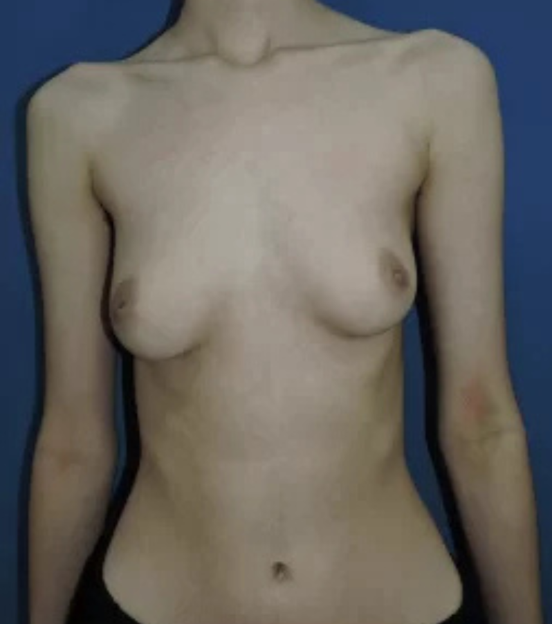 A frontal view of a patient's chest before gender-affirming top surgery with Health & Wellness Bazaar.