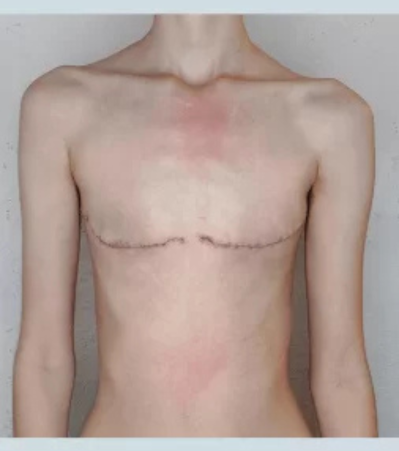 After photo of a patient with a flat, contoured chest following gender-affirming top surgery at Health & Wellness Bazaar.