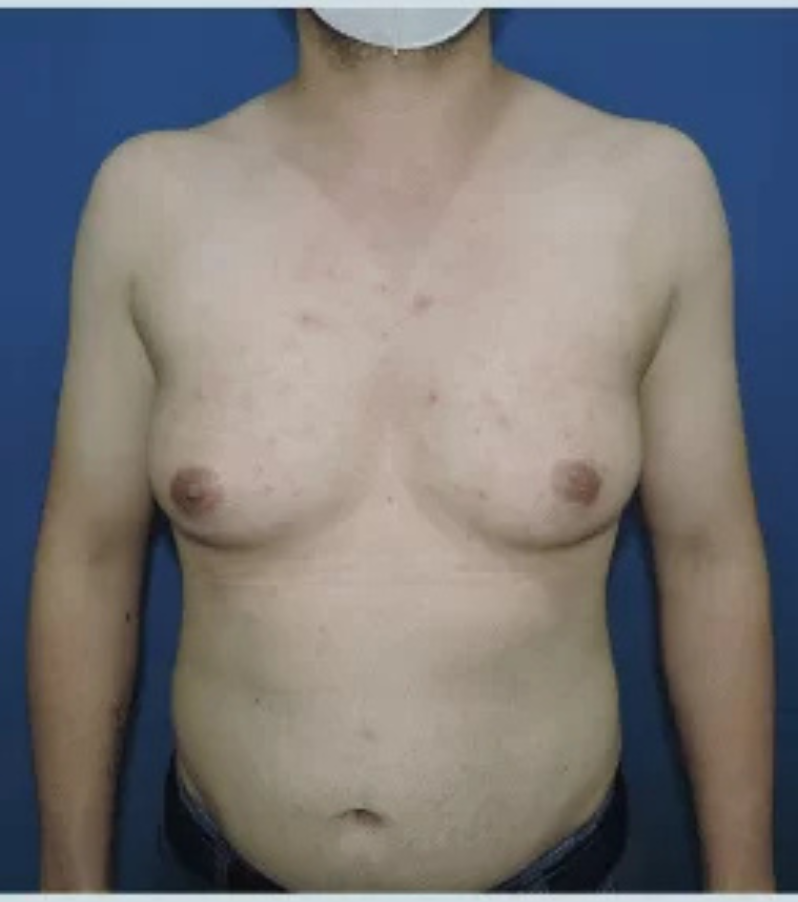 Before a gender-affirming mastectomy, a patient’s chest is shown in a pre-operative photo with Health & Wellness Bazaar.