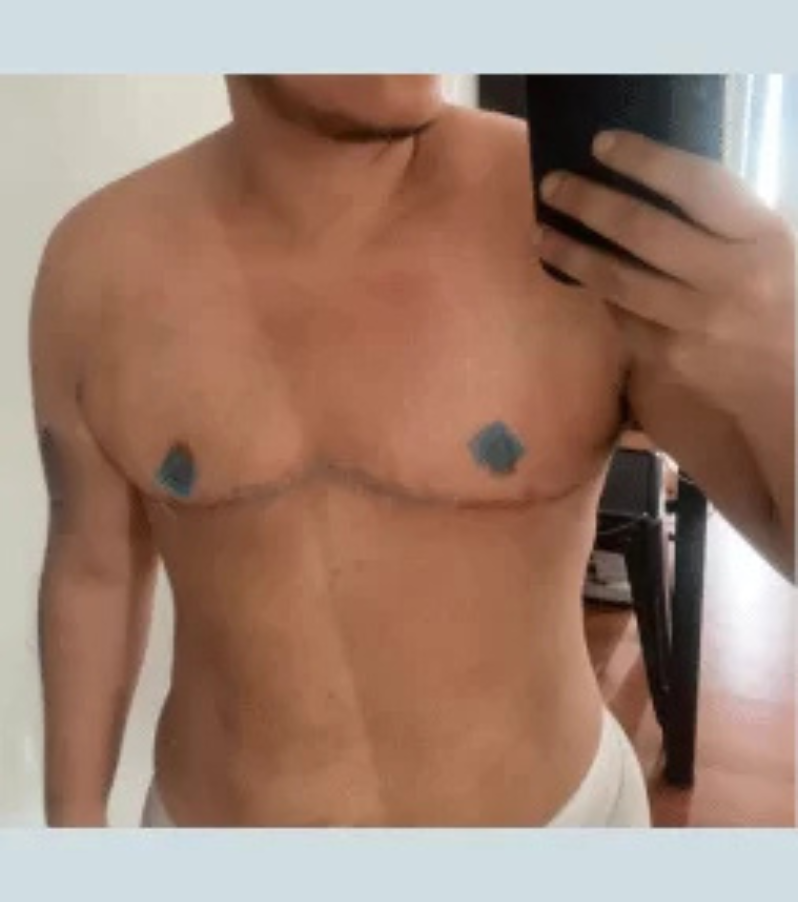 The new chest contour of a patient after a gender-affirming mastectomy with Health & Wellness Bazaar.