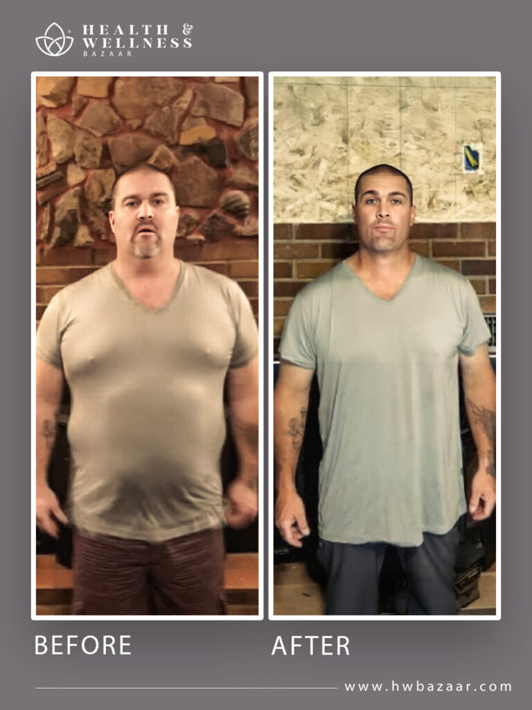 Frontal photograph of a man before and after bariatric surgery. The "before" image shows the man overweight. The "after" image shows significant weight loss, with a flatter abdomen and a leaner physique, reflecting the success of the procedure performed at Health & Wellness Bazaar.