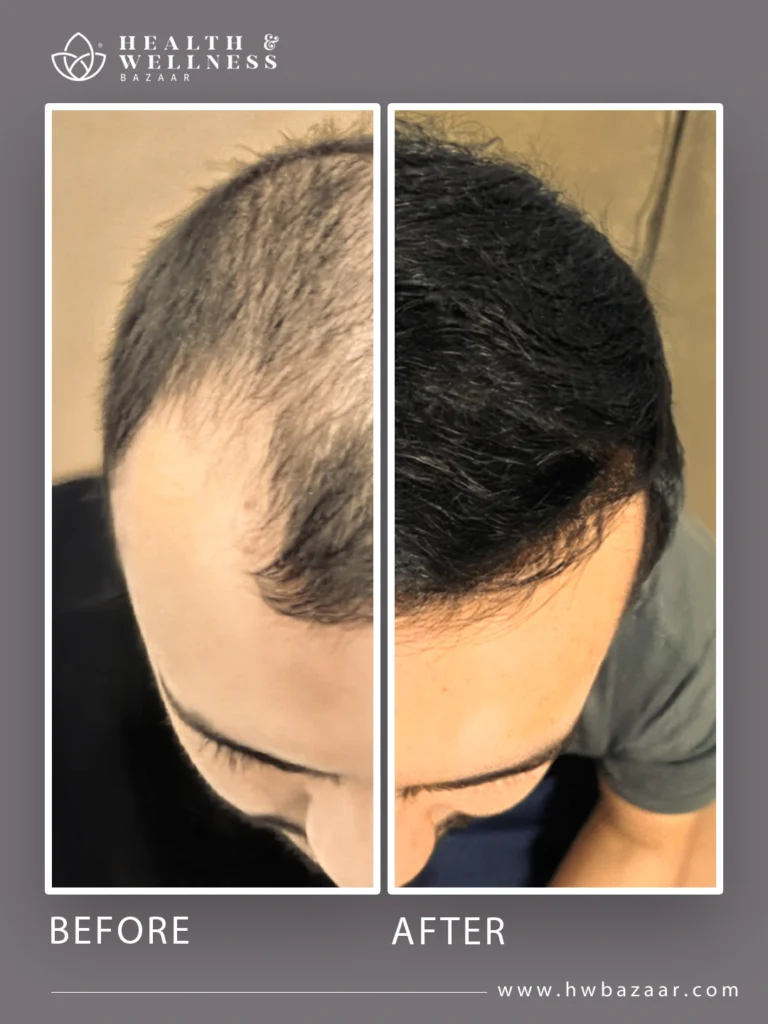 This image shows the before and after of a male patient who underwent a hair transplant at Health & Wellness Bazaar in Tijuana. The "before" photo exhibits significant male pattern baldness on the top and front of his head. The "after" photo shows a completely restored and denser hairline, highlighting the successful recovery of hair density.