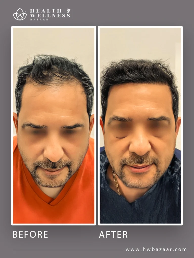 Frontal photograph of a man before and after his hair transplant, showing the change in his hairline and hair density. The "before" image shows thin hair on the front and temples. The "after" image reveals a denser and more uniform head of hair, the result of a successful procedure at Health & Wellness Bazaar.