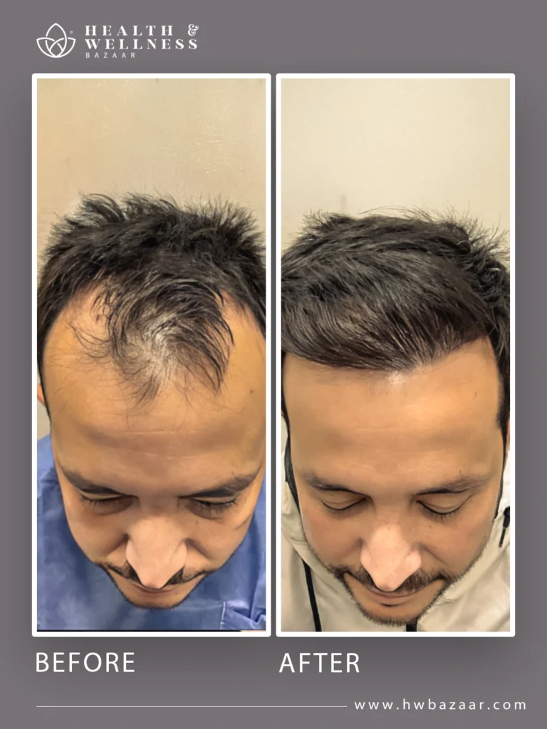 Top-down view of a man's head, before and after a hair transplant. The "before" image shows sparse hair on the crown and front. The "after" image reveals visibly denser hair and full coverage, reflecting the successful procedure performed at Health & Wellness Bazaar.