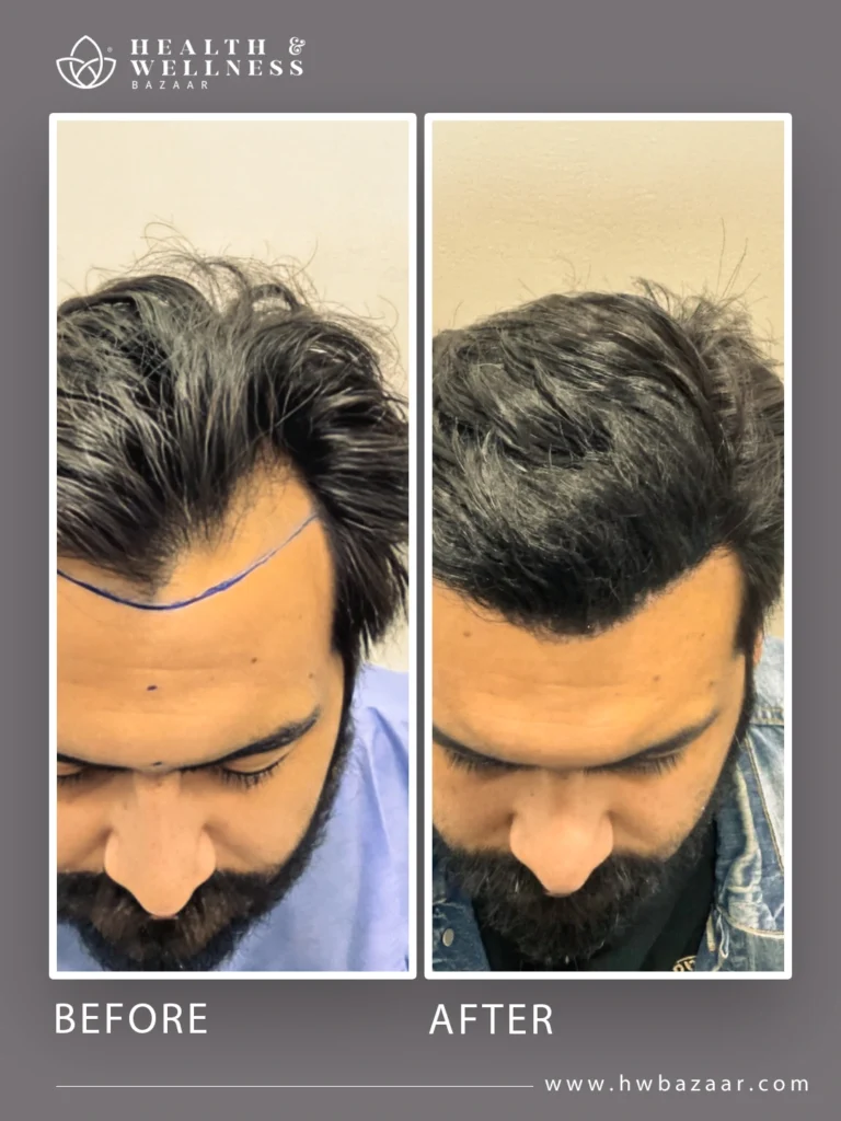 Frontal photograph of a man's face before and after his hair transplant. The "before" image shows the hairline marked with a blue line for the procedure. The "after" image reveals a lower, denser hairline, with the hair completely restored to a natural look, a result of the surgery performed at Health & Wellness Bazaar.