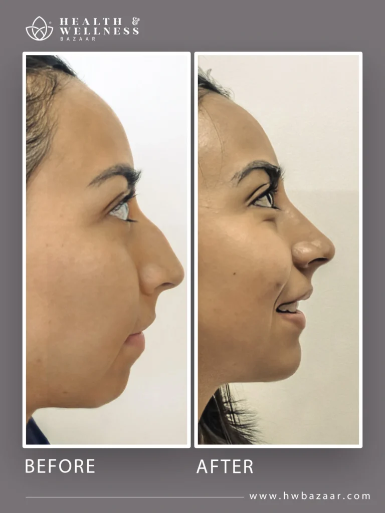 Profile of a woman before and after rhinoplasty. The "before" image shows a nose with a prominent bridge. The "after" image reveals a nose with a smoother bridge and a slightly upturned tip, enhancing facial harmony. The results correspond to a procedure performed at Health & Wellness Bazaar.