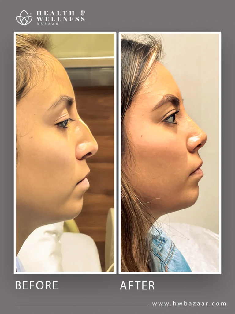 Profile of a woman before and after a rhinoplasty. The "before" image shows a nose with a wide bridge and tip. The "after" image shows a thinner, more defined nose that enhances her facial harmony, a result of a successful procedure at Health & Wellness Bazaar.