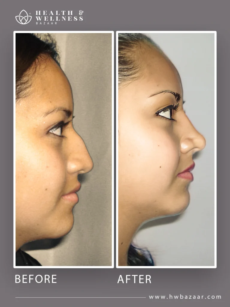 Profile of a woman before and after rhinoplasty. The "before" image shows a nose with a prominent bridge and a drooping tip. The "after" image shows a straighter nose with a refined and elevated tip, resulting in a smoother profile. This is the result of a procedure performed at Health & Wellness Bazaar.