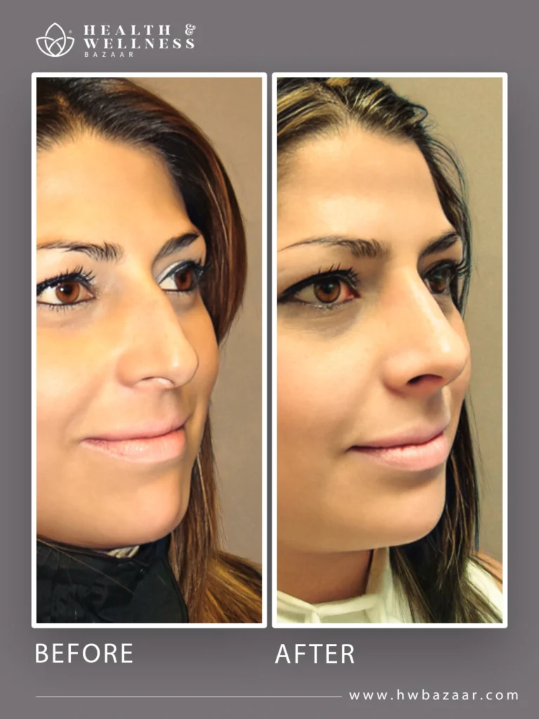 Profile of a woman before and after a rhinoplasty. The "before" image shows a nose with a prominent nasal bridge. The "after" image shows a straighter and more refined nose, resulting in a more balanced facial profile. The procedure was performed at Health & Wellness Bazaar.