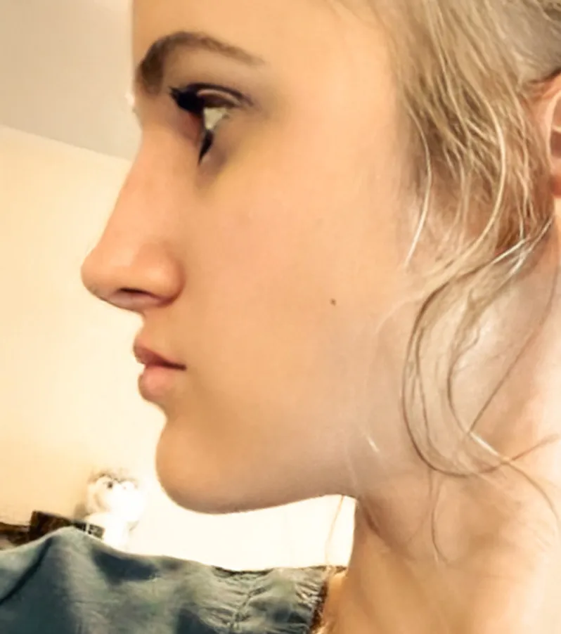 Safe and Affordable Surgery in Tijuana | Health & Wellness Bazaar 30 Profile photograph of a woman's face after rhinoplasty. The nose has a straighter bridge and a lifted tip.