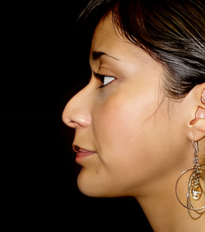 Profile photograph of a woman's face before rhinoplasty, showing a nose with a visible bump on the bridge.