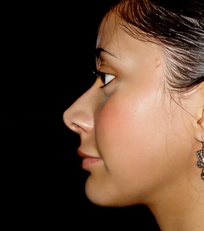 Profile photograph of a woman's face after rhinoplasty, showing a nose with a smoother, straighter bridge.