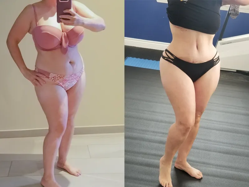 Medical Tourism in Tijuana | Affordable Surgery Packages 17 MMO2