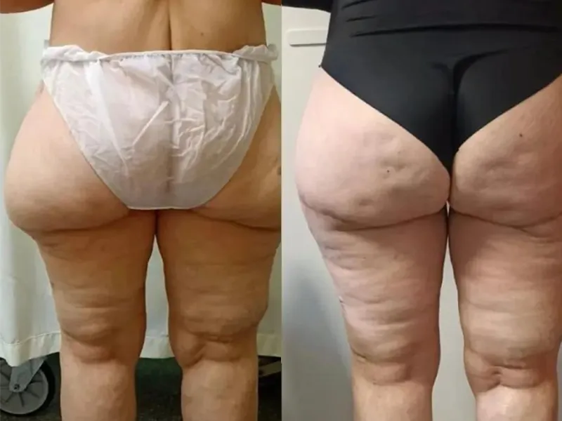 Medical Tourism in Tijuana | Affordable Surgery Packages 19 thigh lift