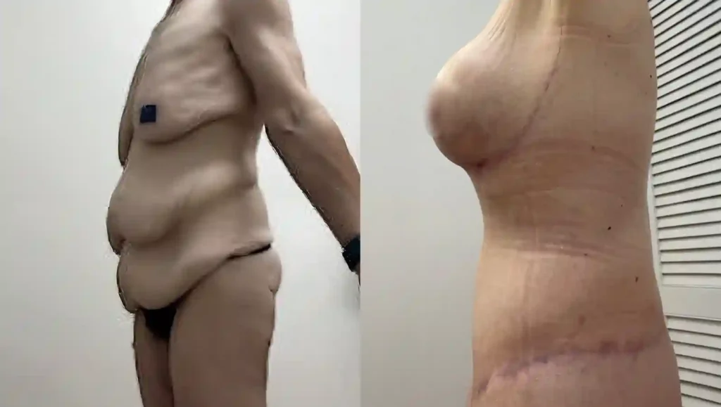 Before and after comparison of Buttock Lift and Thigh Lift surgery in Tijuana; the left image shows sagging, and the right shows a firmer, lifted contour.