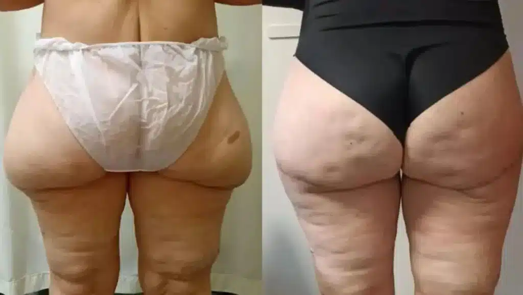Before and after comparison of a Lower Body Lift surgery in Tijuana, showing the removal of sagging skin on buttocks and thighs after weight loss.