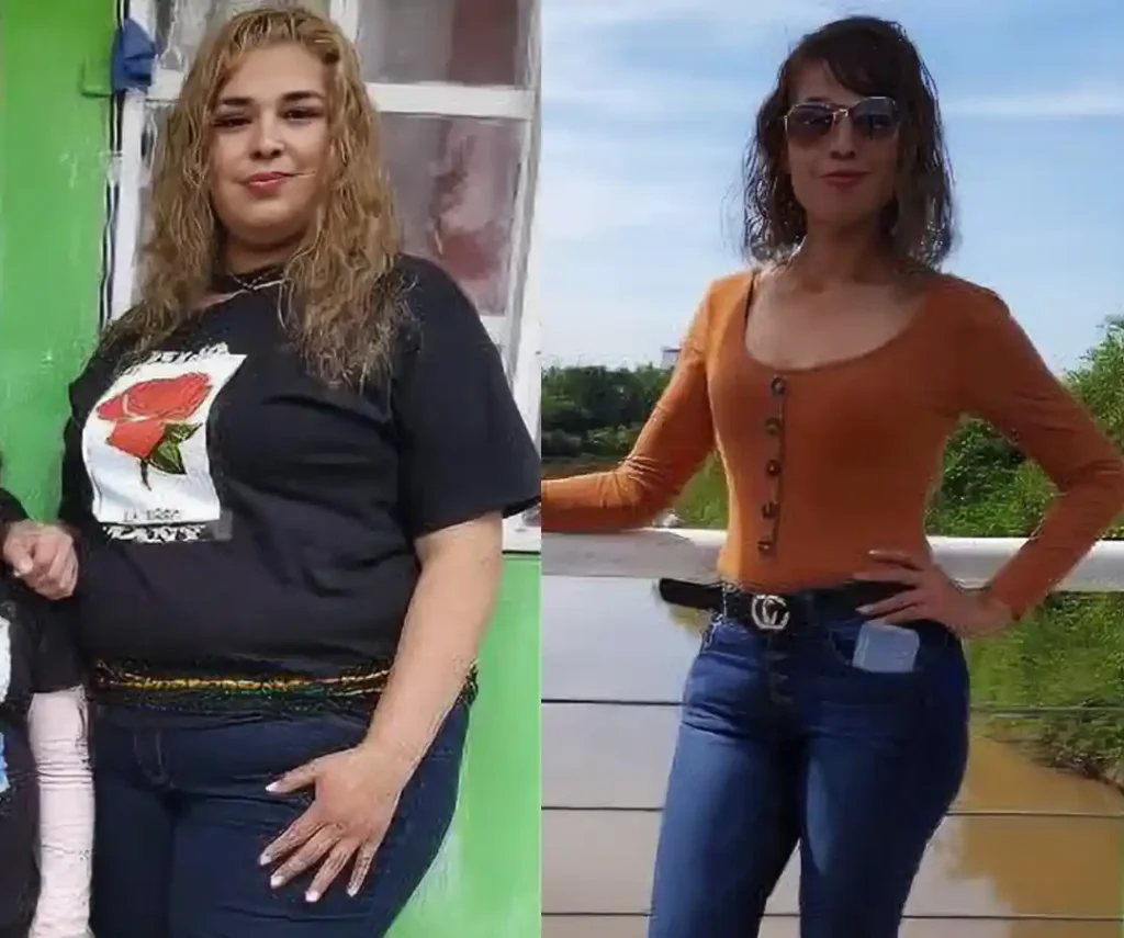 Before and after comparison showing dramatic weight loss results from gastric sleeve surgery in Tijuana, highlighting the effectiveness of bariatric surgery Tijuana.