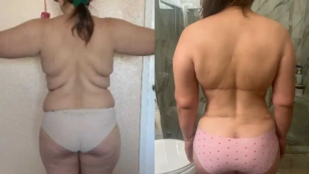Back comparison showing the removal of severe skin folds after an Upper Body Lift performed by HWBazaar surgeons.
