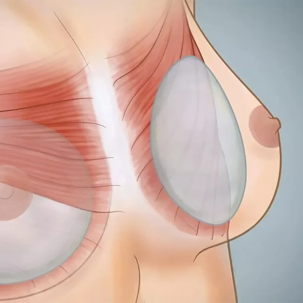 Breast Augmentation In Tijuana, Mexico 14 Medical illustration showing submuscular breast implant placement (under the pectoral muscle), a technique used by board-certified plastic surgeons for natural breast augmentation in Tijuana.
