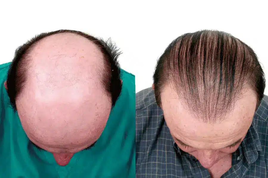 Top-down comparison of severe baldness (Norwood 6) versus full coverage achieved via high-density hair implants in Tijuana and hair restoration.