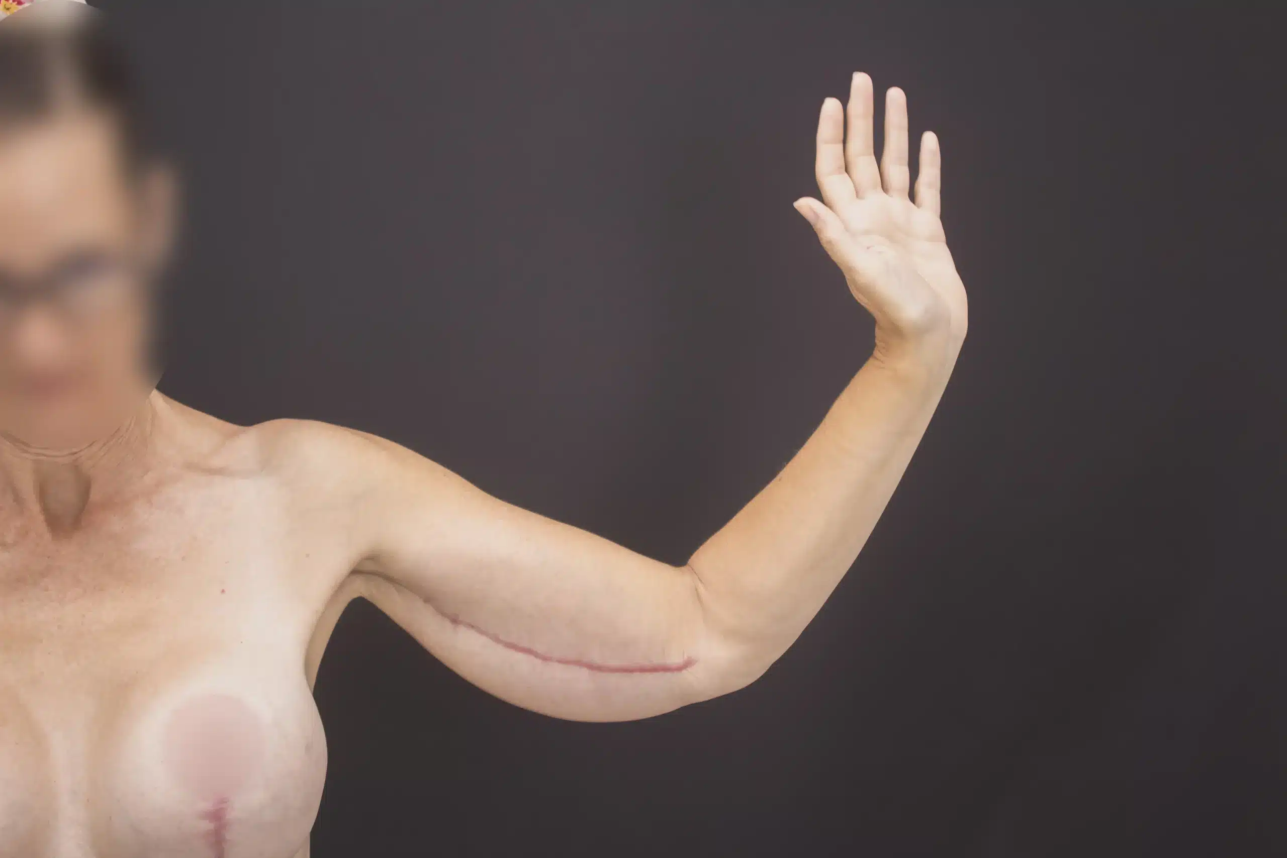 Arm Lift in Tijuana, Mexico 13 Post-operative view of a healing incision along the inner arm of a patient after an Arm Lift in Tijuana, demonstrating the placement used for arm skin removal.