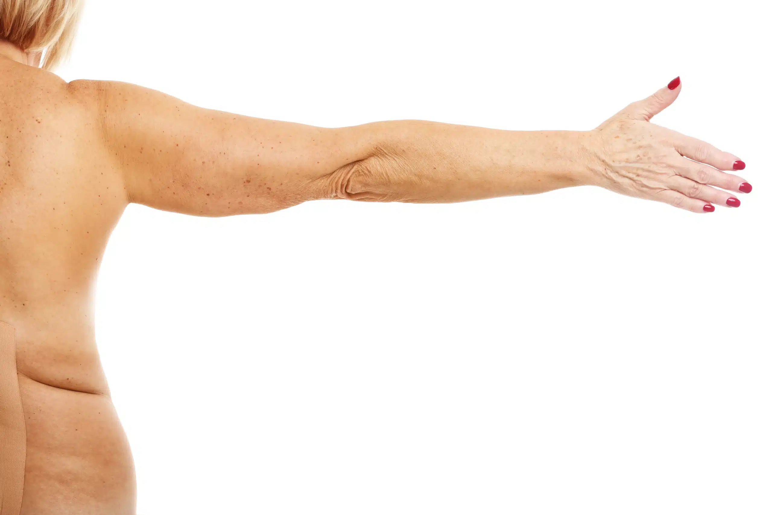 Arm Lift in Tijuana, Mexico 12 Rear view of a woman's extended arm showing significant loose skin and lack of tone, illustrating the ideal candidate for arm skin removal in Tijuana and brachioplasty.