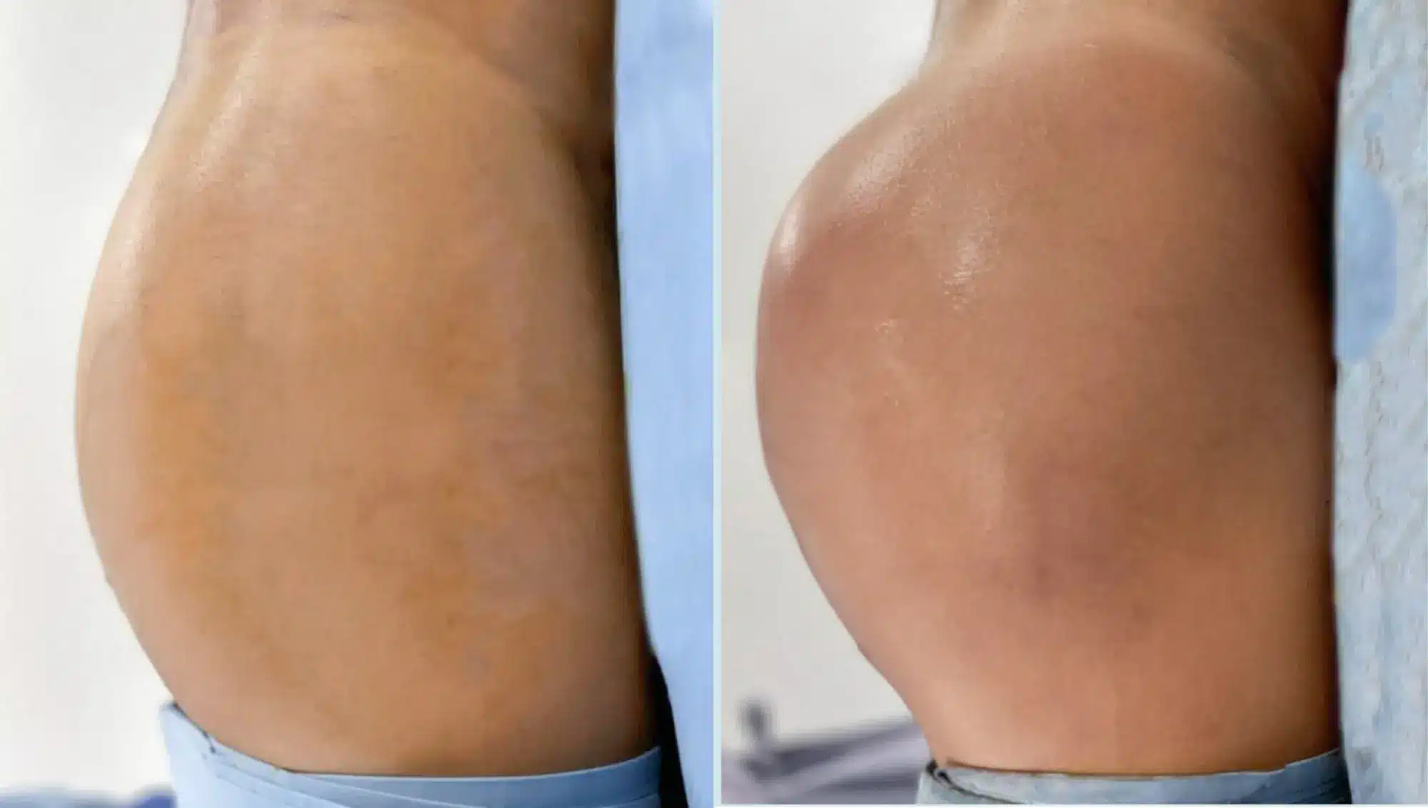 Side profile comparison of a patient before and after a Brazilian Butt Lift in Tijuana, showing increased gluteal volume and projection achieved via Brazilian butt augmentation.
