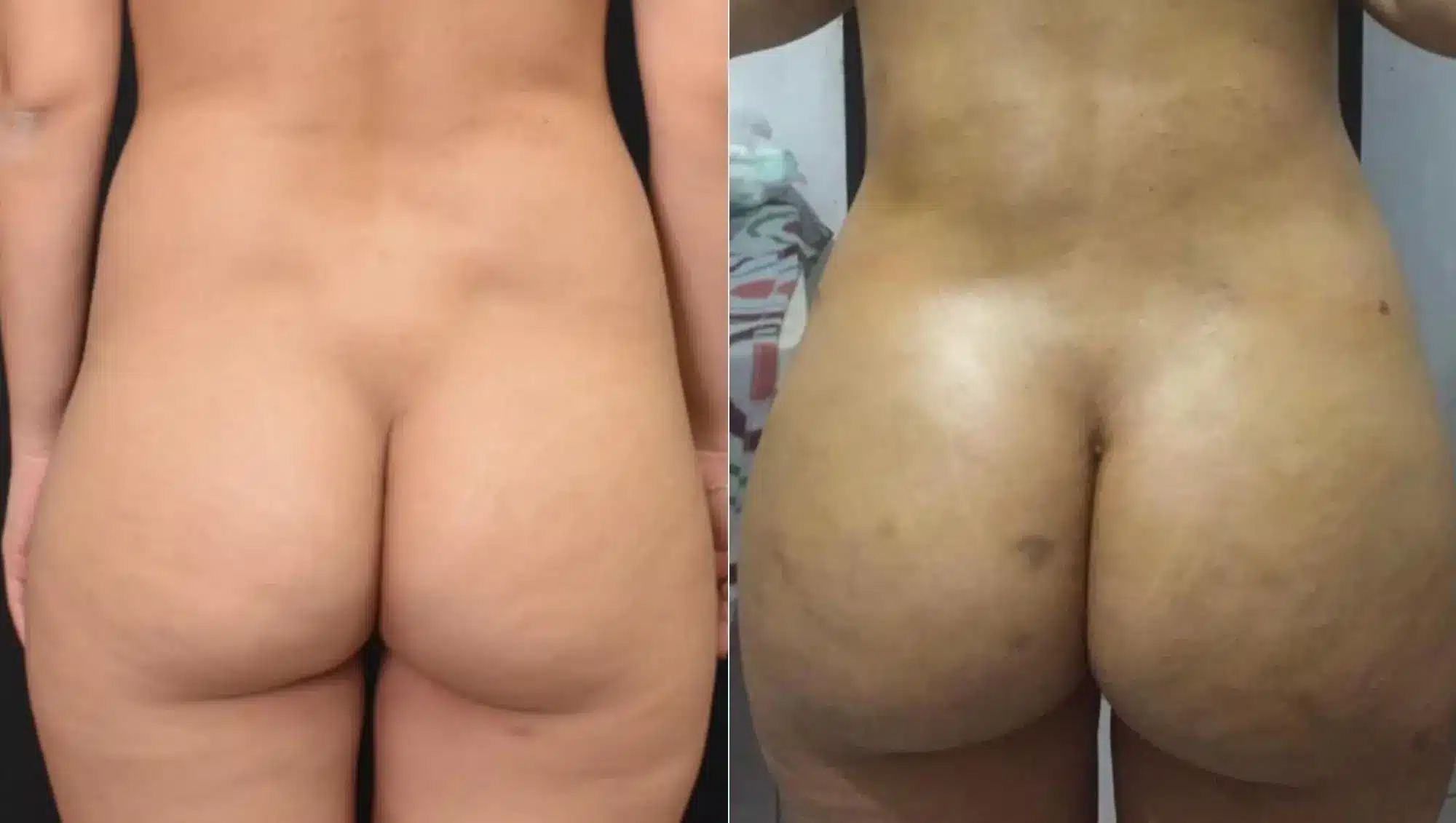 Rear view comparison of a patient before and after Brazilian Butt Lift in Tijuana, showing correction of hip dips and significant volume increase via Brazilian butt augmentation.