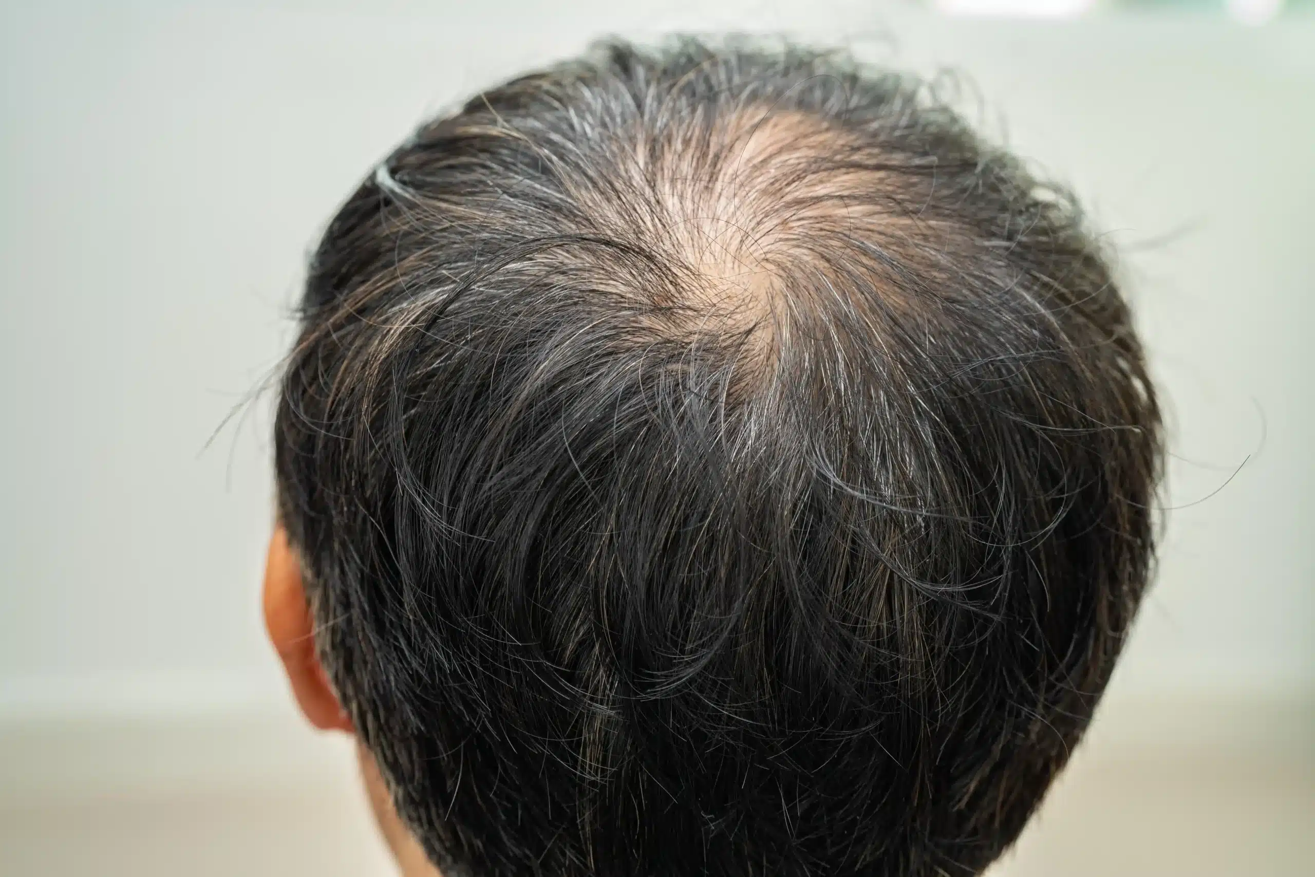 Hair Restoration in Tijuana, Mexico 13 Top view of a man's head showing significant hair thinning at the crown (vertex), illustrating a common target area for hair restoration in Tijuana and hair implants.
