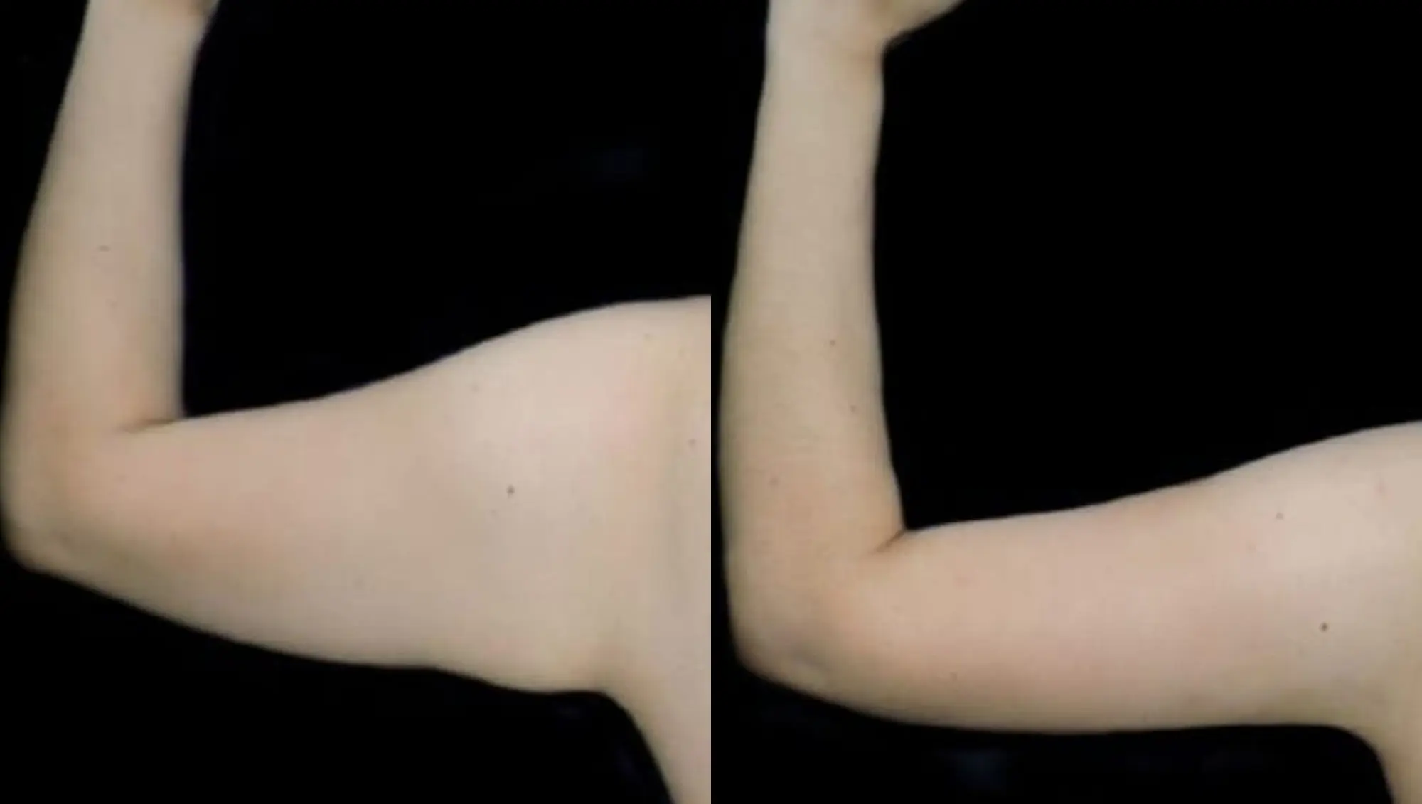 Top view before and after hair regrowth in Tijuana treatment, showing full coverage of the crown area.