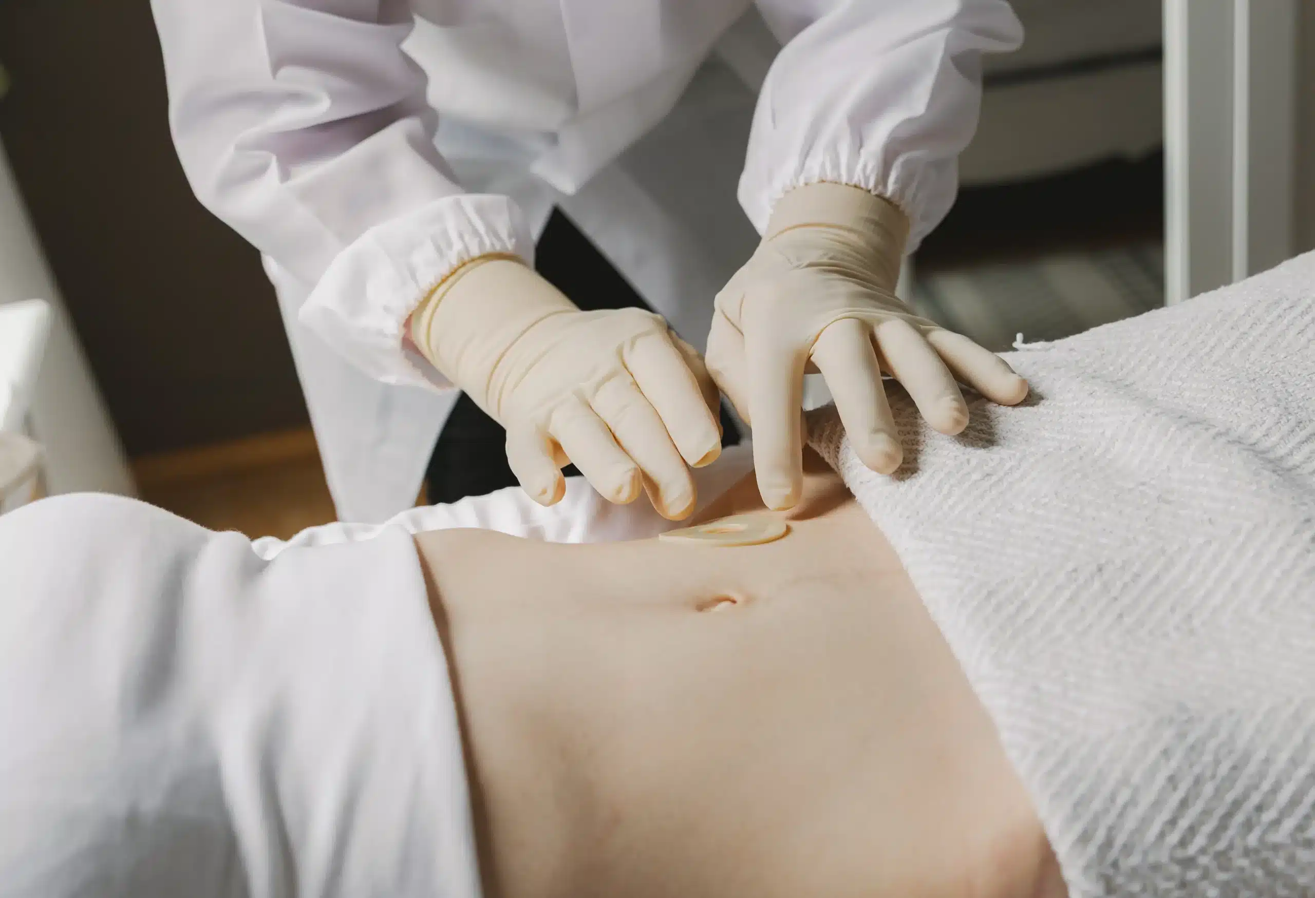 Liposuction in Tijuana, Mexico 18 Nurse with sterile gloves applying a protective dressing to a patient's abdomen after liposuction in Tijuana, ensuring proper healing for body contouring patients.