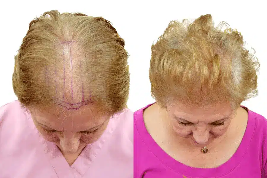 Top view of a female patient before and after hair implants in Tijuana, showing significant density improvement along the part line.