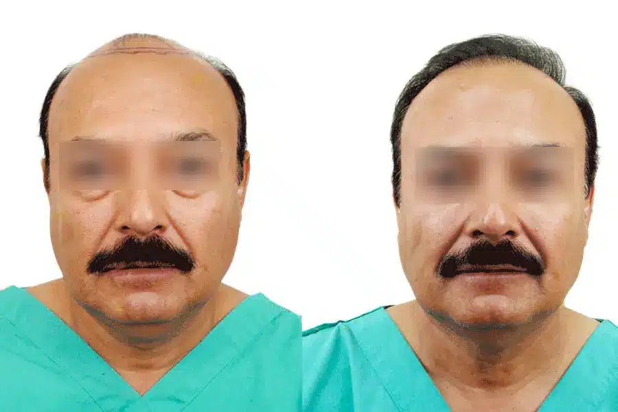 Frontal view of a male patient before and after hair restoration in Tijuana, showing a lowered, natural hairline designed by Dr. Jorge Cortez.