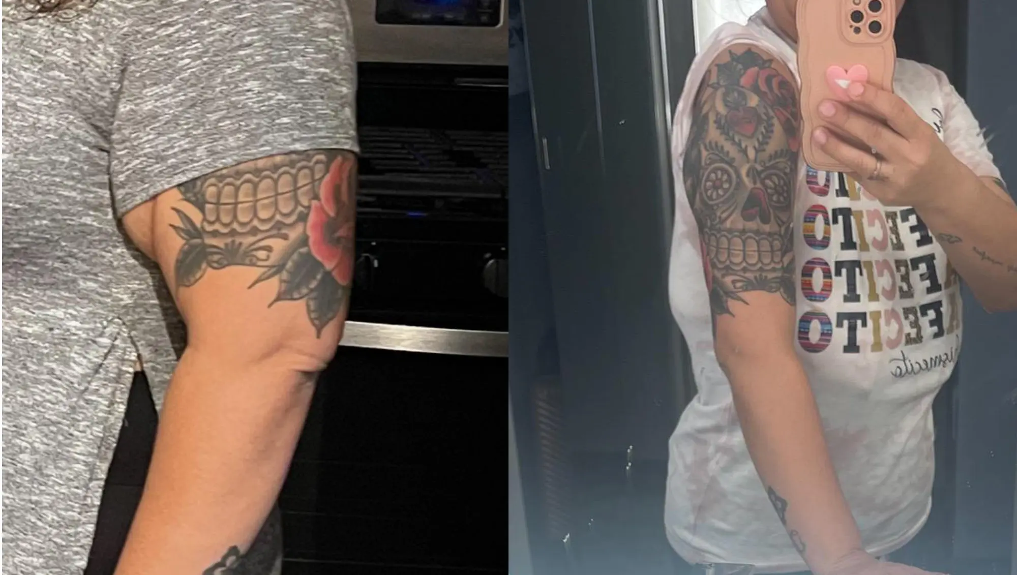 Sleeveless Confidence Real Arm Lift Patient Results in Tijuana