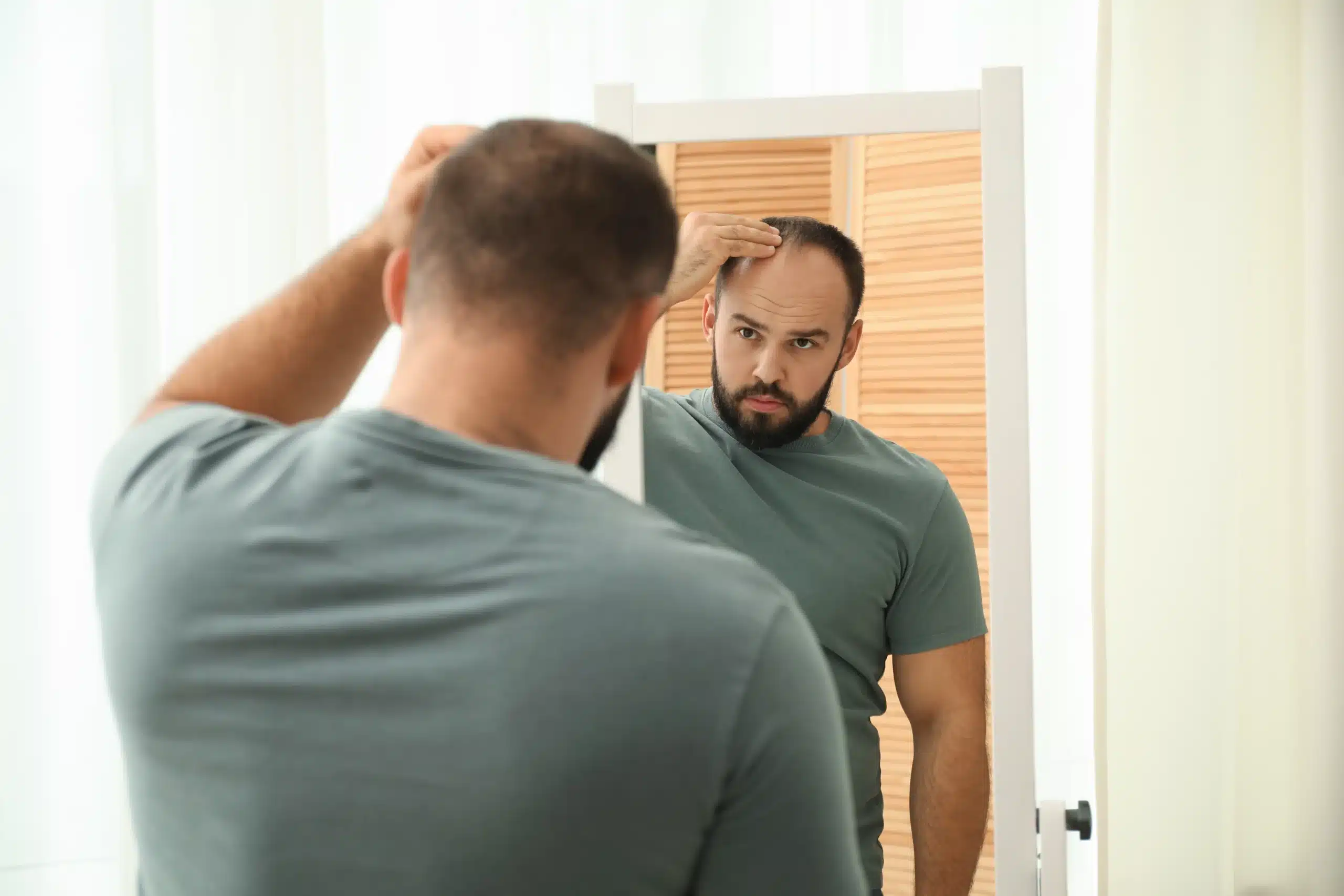 Hair Restoration in Tijuana, Mexico 15 Man examining his receding hairline in a mirror, evaluating the need for hair restoration in Tijuana to correct male pattern baldness.