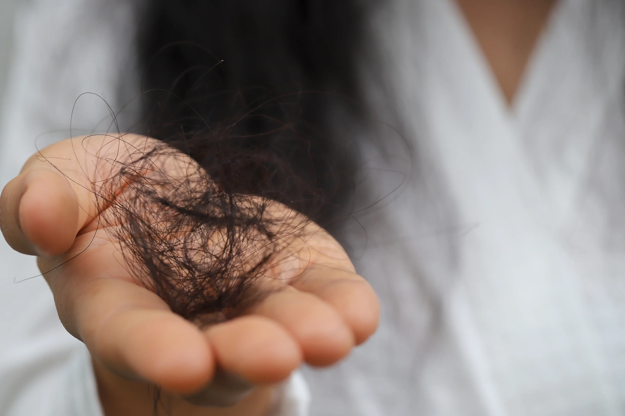 Hair Regrowth in Tijuana, Mexico 11 Close-up of a person experiencing significant hair loss, searching for hair regrowth in Tijuana.