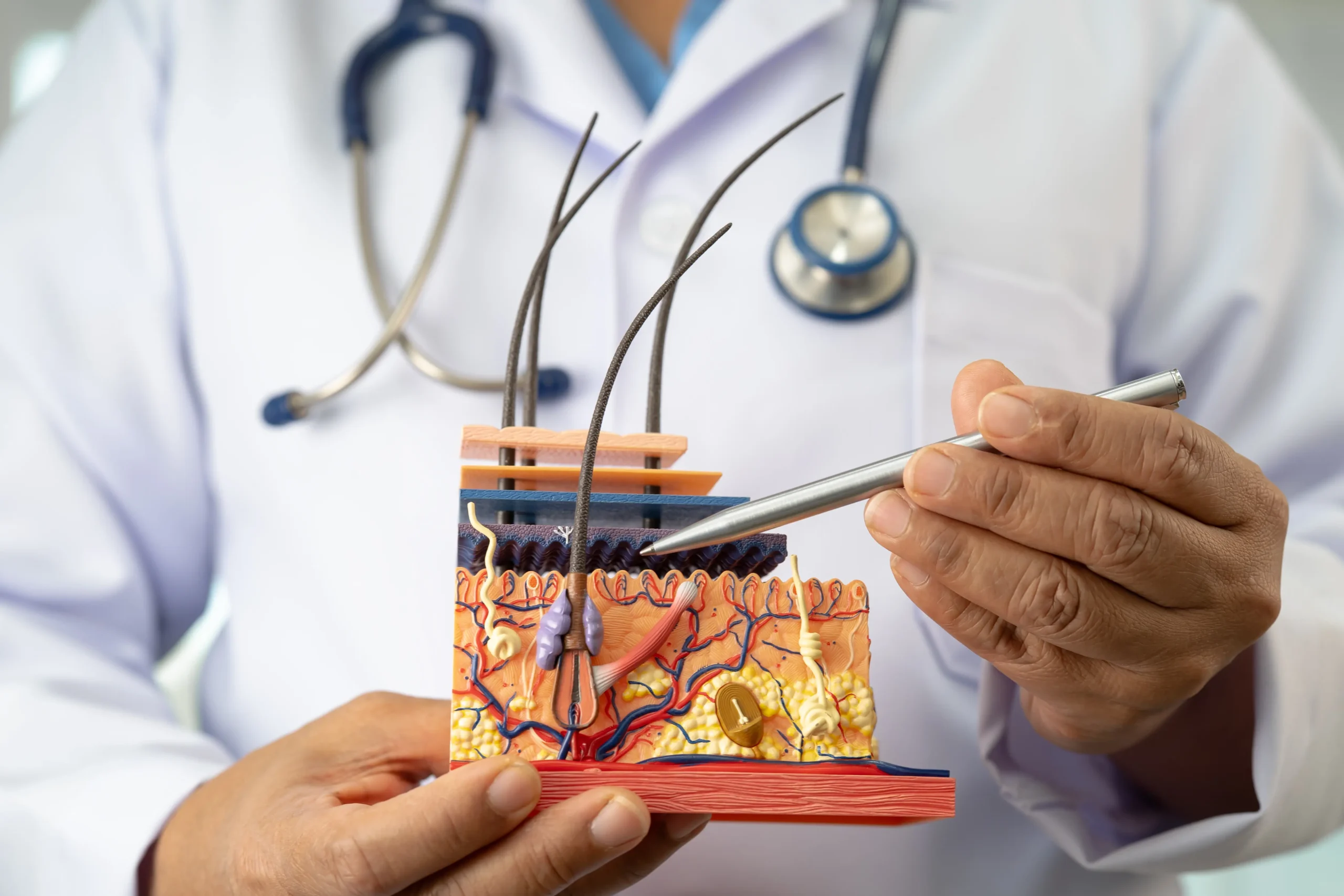 Hair Implants in Tijuana, Mexico 17 A hair restoration specialist in Tijuana explaining the hair follicle structure using a medical skin model to a patient.