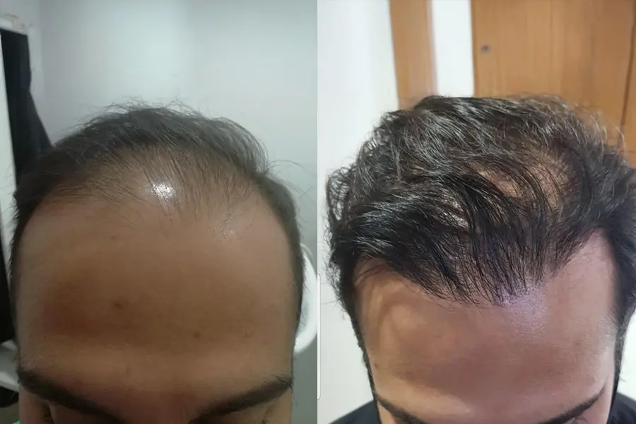 Before and after results of a hair transplant in Tijuana showing frontal hairline restoration and increased density.