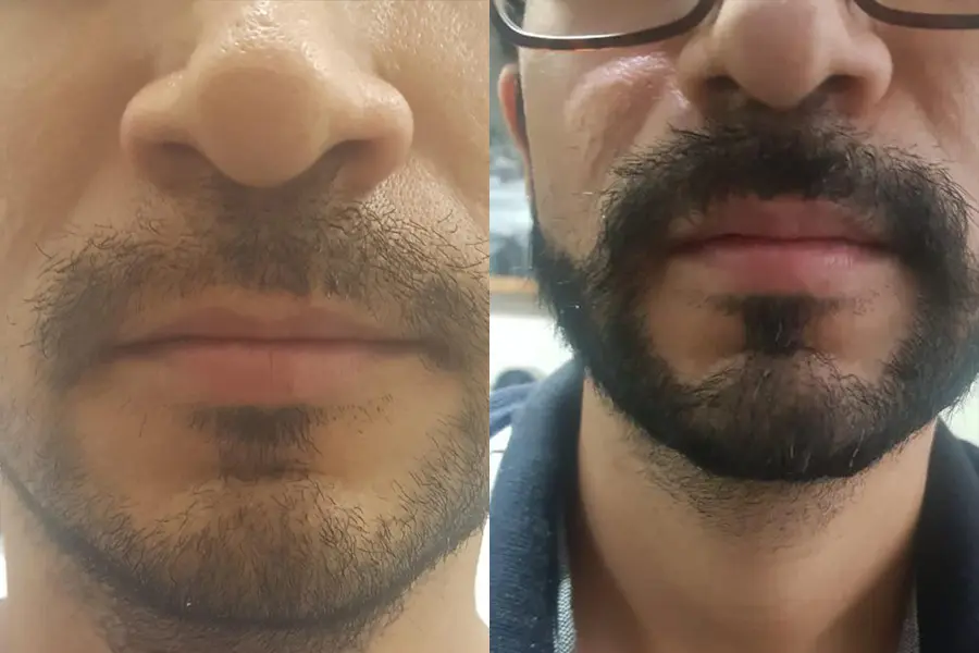 Full face before and after of a patient after receiving a hair transplant from the highest rated hair transplant doctor in Mexico.