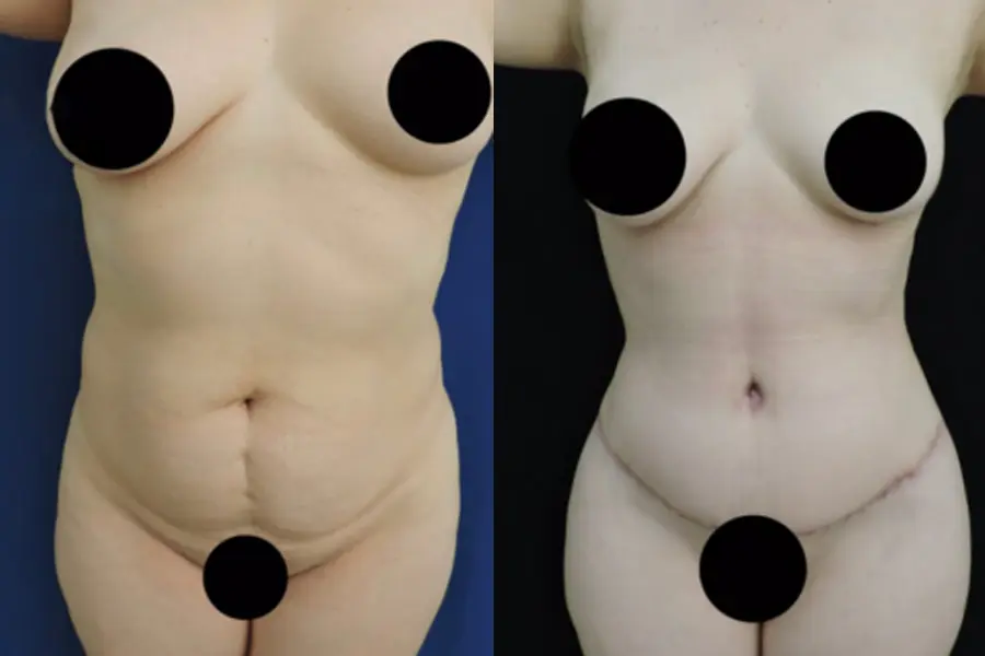 Frontal before and after comparison of a female patient after a tummy tuck in Tijuana with muscle repair.