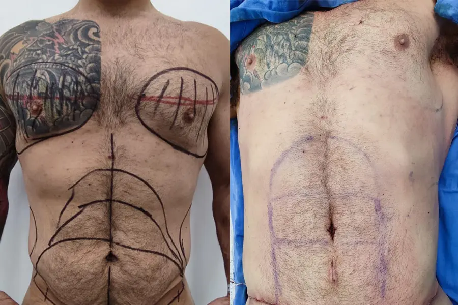 Before and after of a male patient who underwent high-definition abdominal liposculpture in Tijuana, Mexico.