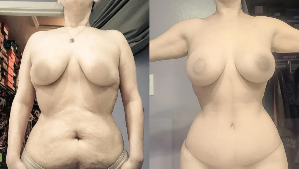Side-by-side comparison of a mommy makeover surgery, showing breast lift and tummy tuck results.