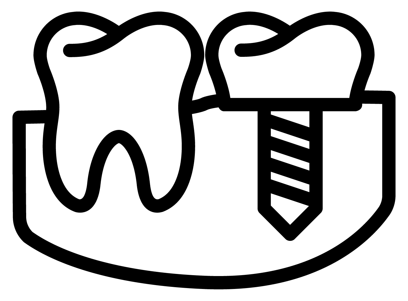 Tooth Implants in Tijuana, Mexico 13 Technical icon showing the structure of a dental implant in the jawbone.