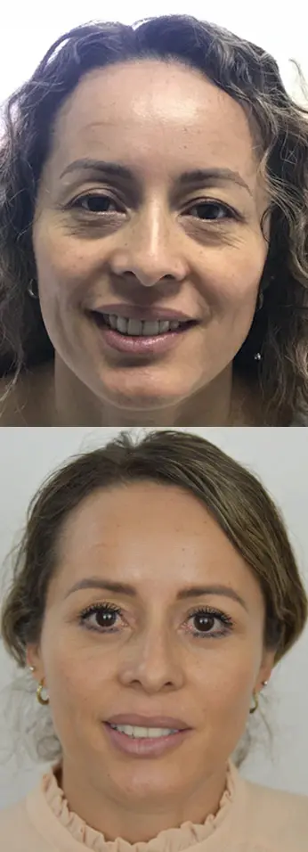 Facelift in Tijuana, Mexico 12 Before and after comparison of a female patient showing significant rejuvenation following a facelift in Tijuana, Mexico.