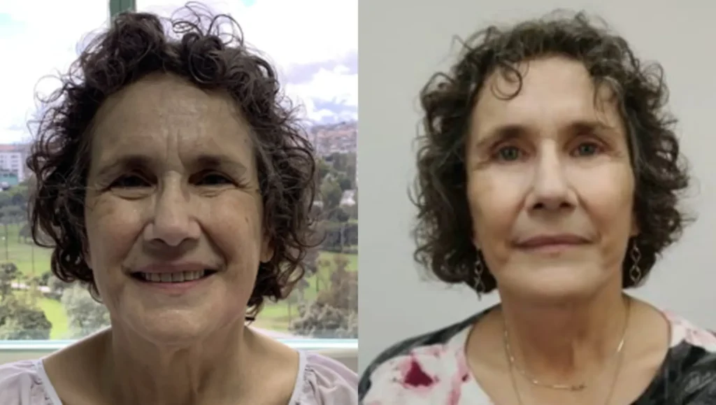 Before and after comparison of an older woman showcasing natural-looking facial rejuvenation surgery in Tijuana.