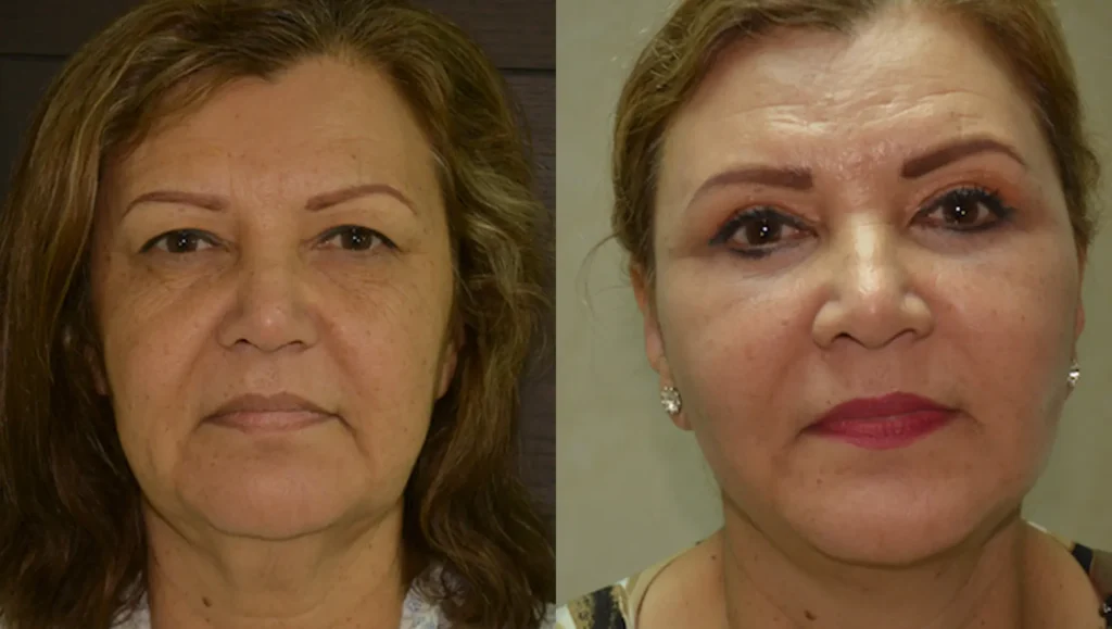 Before and after front view comparison of a woman showing facial skin tightening and rejuvenation after a facelift in Tijuana.