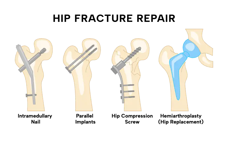 Hip Replacement in Tijuana, Mexico 14 Medical diagram illustrating hip fracture repair methods: Intramedullary Nail, Parallel Implants, Compression Screw, and Hemiarthroplasty for hip replacement in Tijuana.