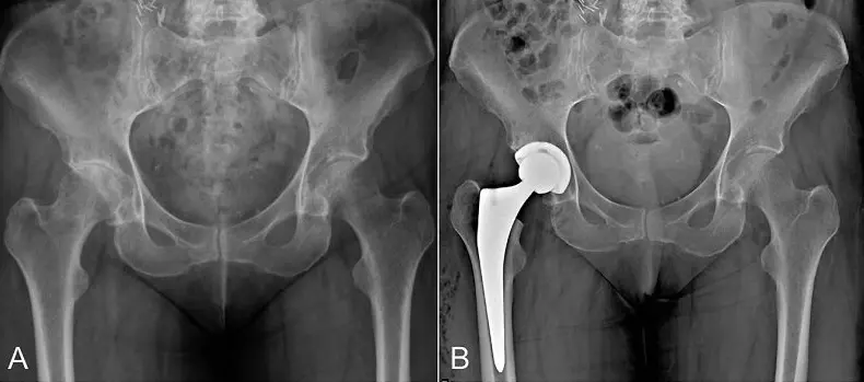Hip Replacement in Tijuana, Mexico 11 X-ray comparison showing a pelvis before and after a hip replacement in Tijuana, highlighting the prosthetic implant.