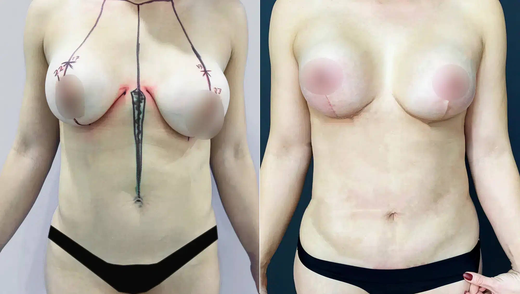 Breast Reduction In Tijuana, Mexico 15 Resultados de mastopexy reduction Tijuana: comparativa de marcas quirúrgicas y resultado final del levantamiento.